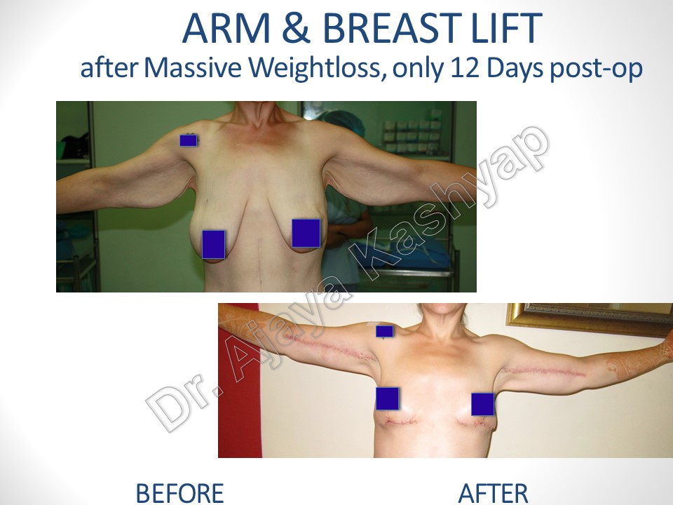 upper body lift - bestbodyliftsurgery.com
